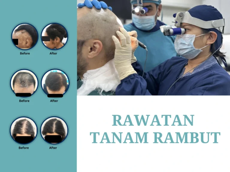 rawatan-tanam-rambut-klinik,rawatan-tanam-rambut-malaysia,rawatan-tanam-rambut-glojas