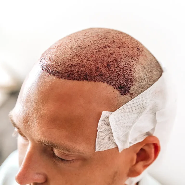 scalp micropigmentation malaysia