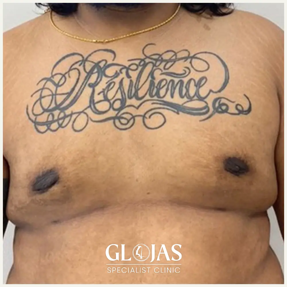 4plastic surgery malaysia before after Gynecomastia 3