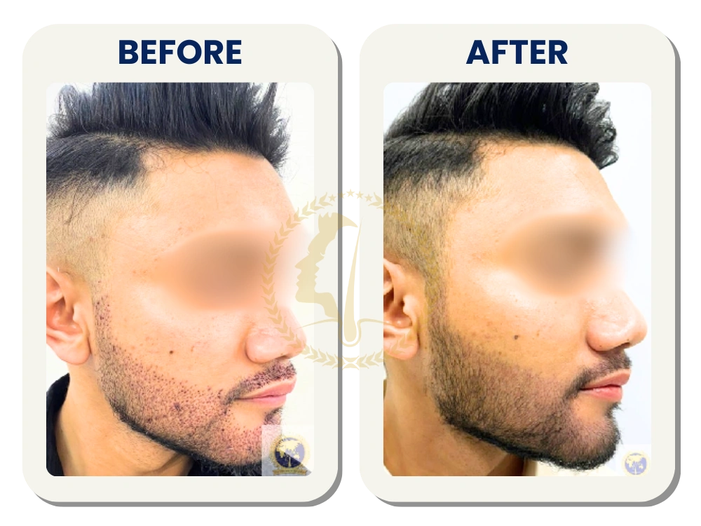 beard-transplant-malaysia-before-after