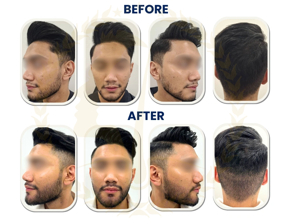 beard-transplant-malaysia-before-after