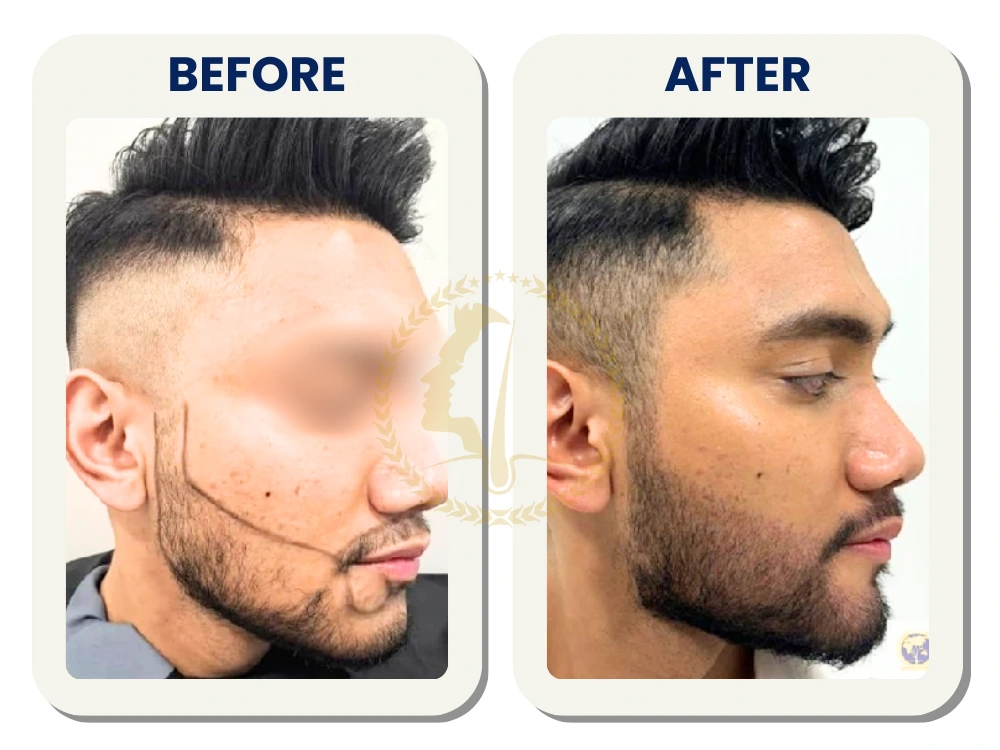 beard-transplant-malaysia-before-after