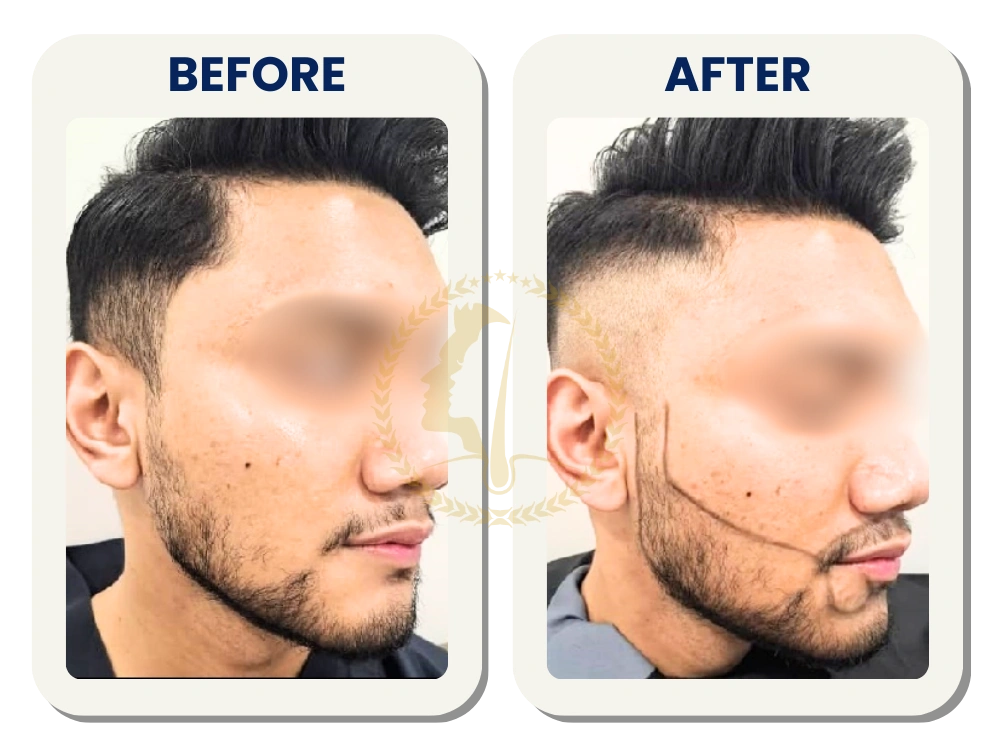 beard-transplant-malaysia-before-after