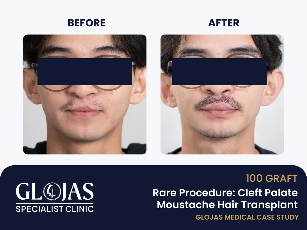 Rare Procedure: Cleft Palate Moustache Hair Transplant Performed at Glojas Specialist Clinic