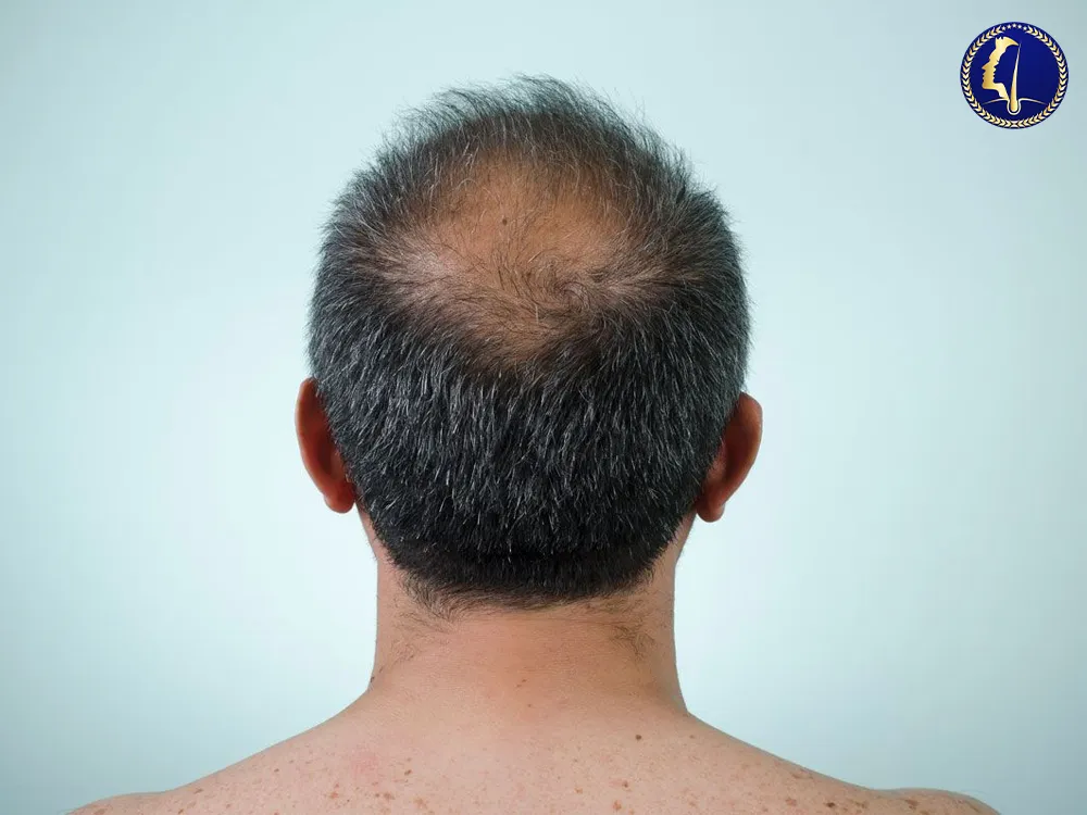 fue-hair-transplant-malaysia-glojas-post-2