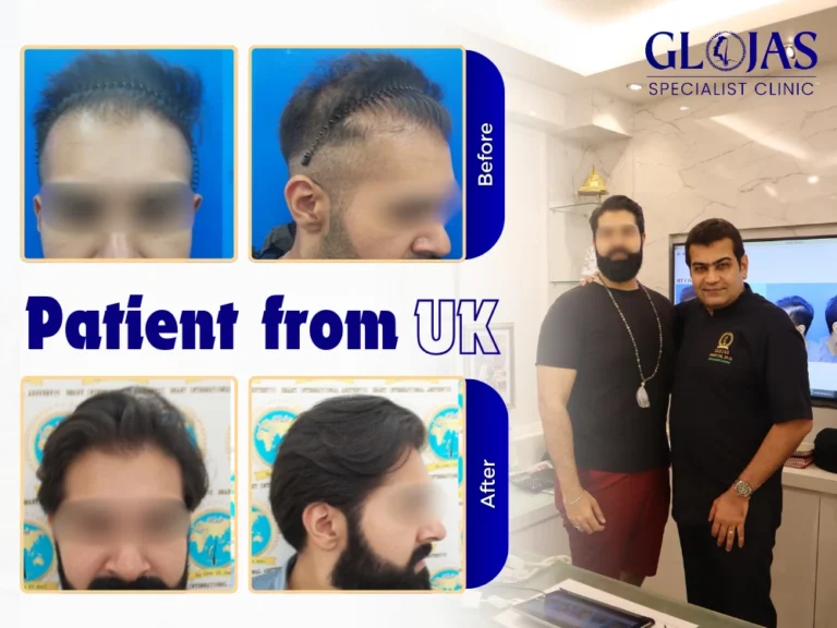 hair-transplant-malaysia