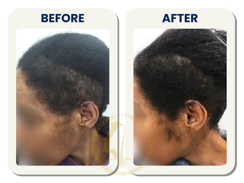 hair-transplant-malaysia-before-after