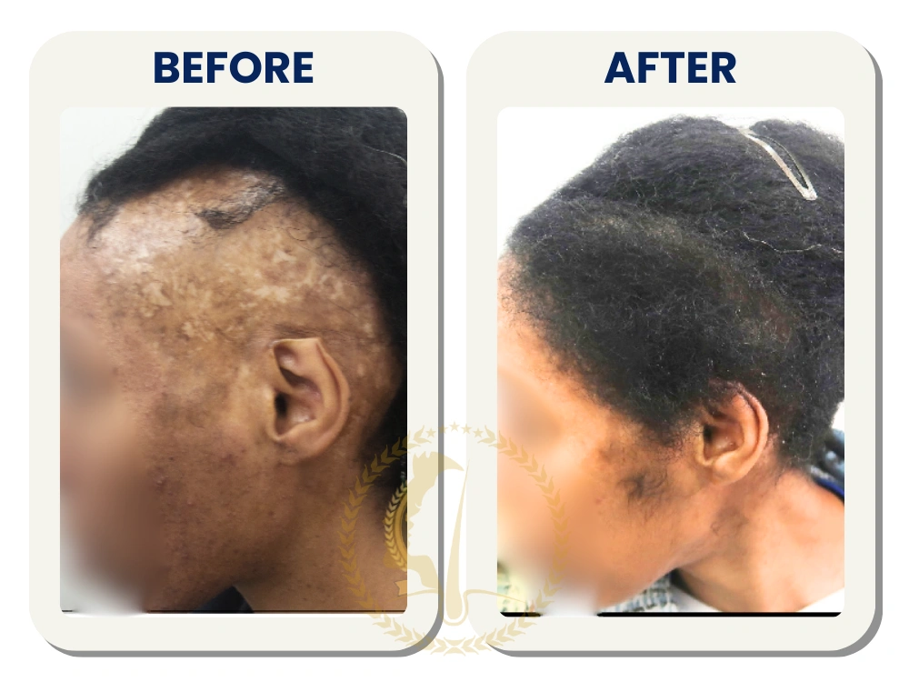 hair-transplant-malaysia-before-after