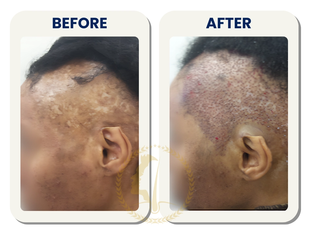 hair-transplant-malaysia-before-after