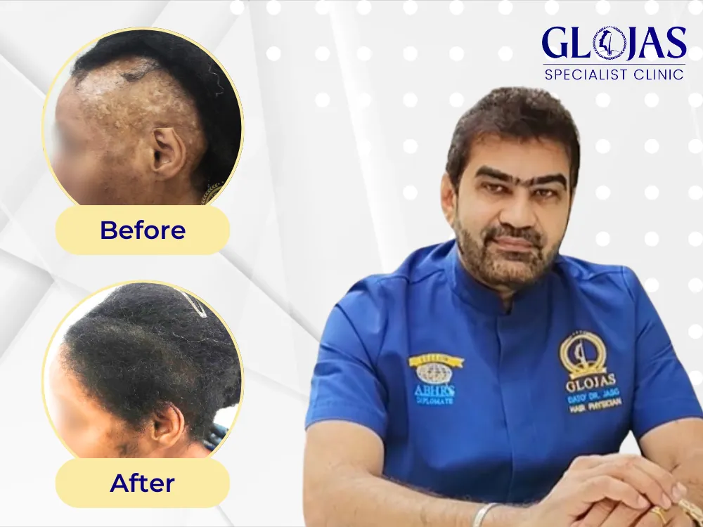 Transforming a Burned Scalp with FUE Hair Transplant