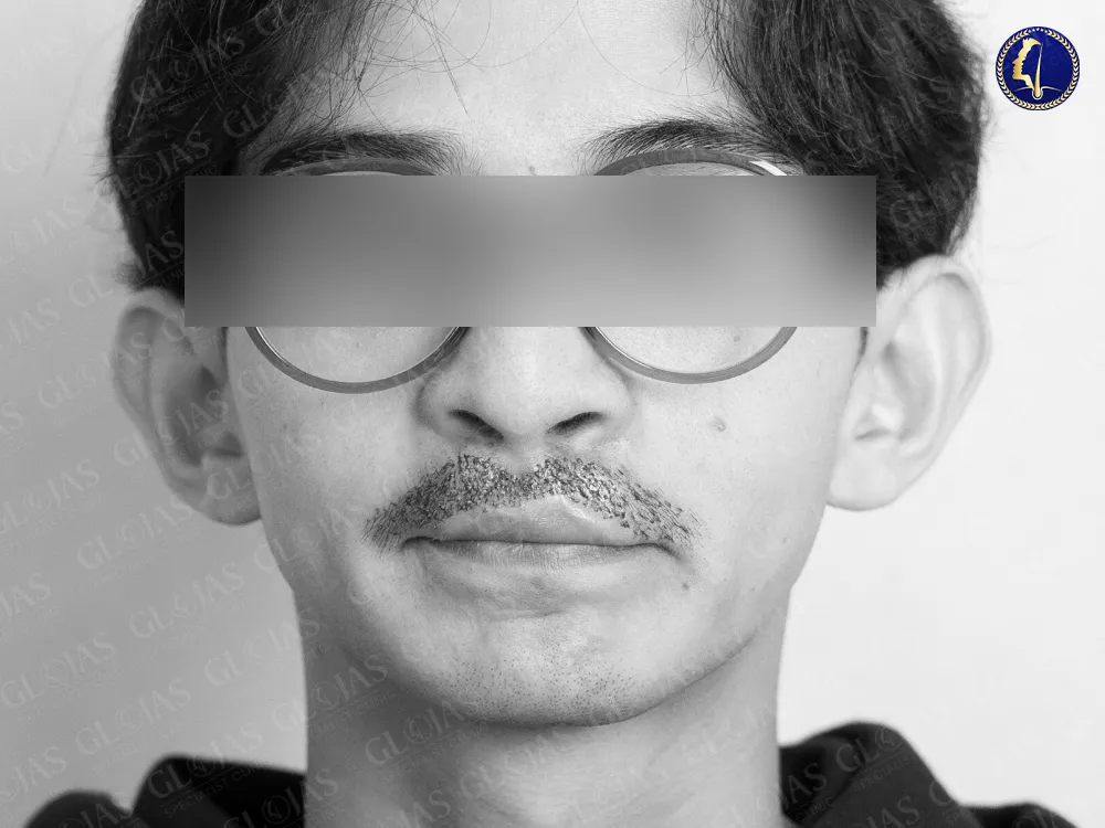 hair-transplant-malaysia-cleft-palate-moustache-transplant-aesthetic-clinic-3