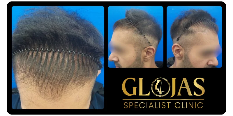 hair-transplant-malaysia-hair-loss