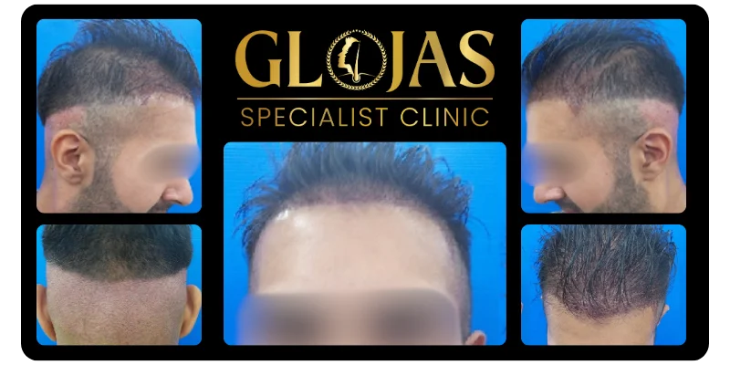 hair-transplant-malaysia-hair-loss