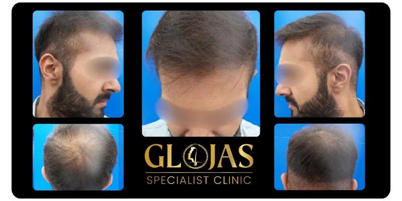 hair-transplant-malaysia-hair-loss