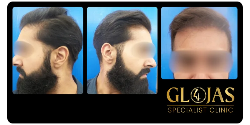 hair-transplant-malaysia-hair-loss