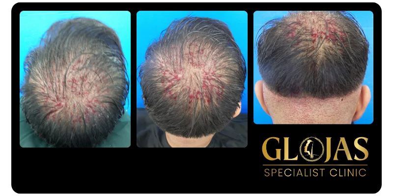 hair-transplant-malaysia-hair-loss