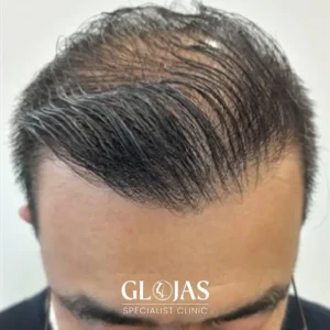 hair-transplant-malaysia-specialist-AFTER-14