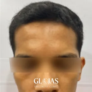 hair-transplant-malaysia-specialist-after-1