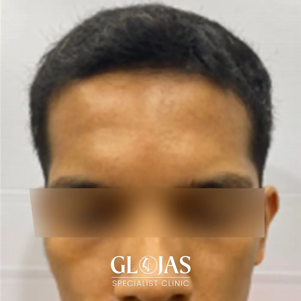 hair transplant malaysia specialist after 1 1