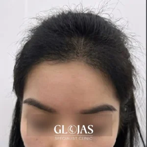 hair-transplant-malaysia-specialist-after-13