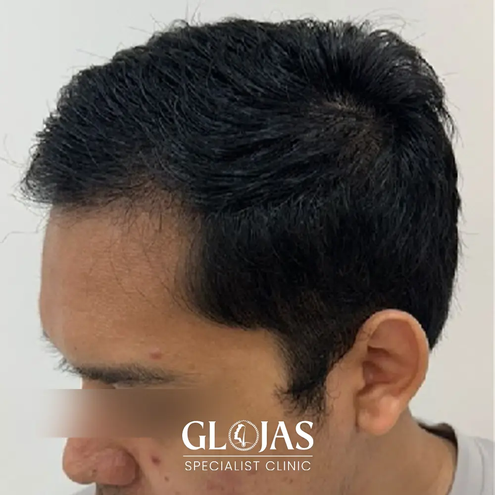 hair transplant malaysia specialist after 3 2