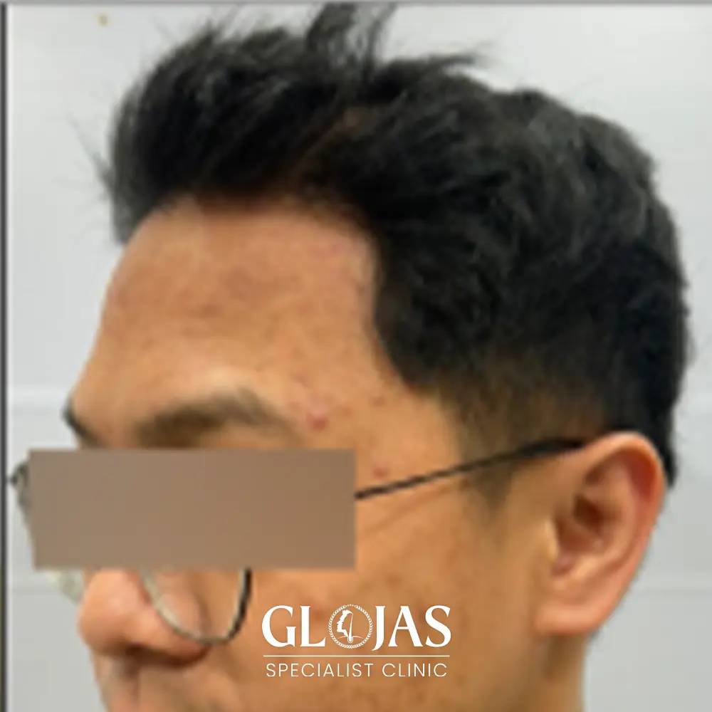 hair transplant malaysia specialist after 4 1