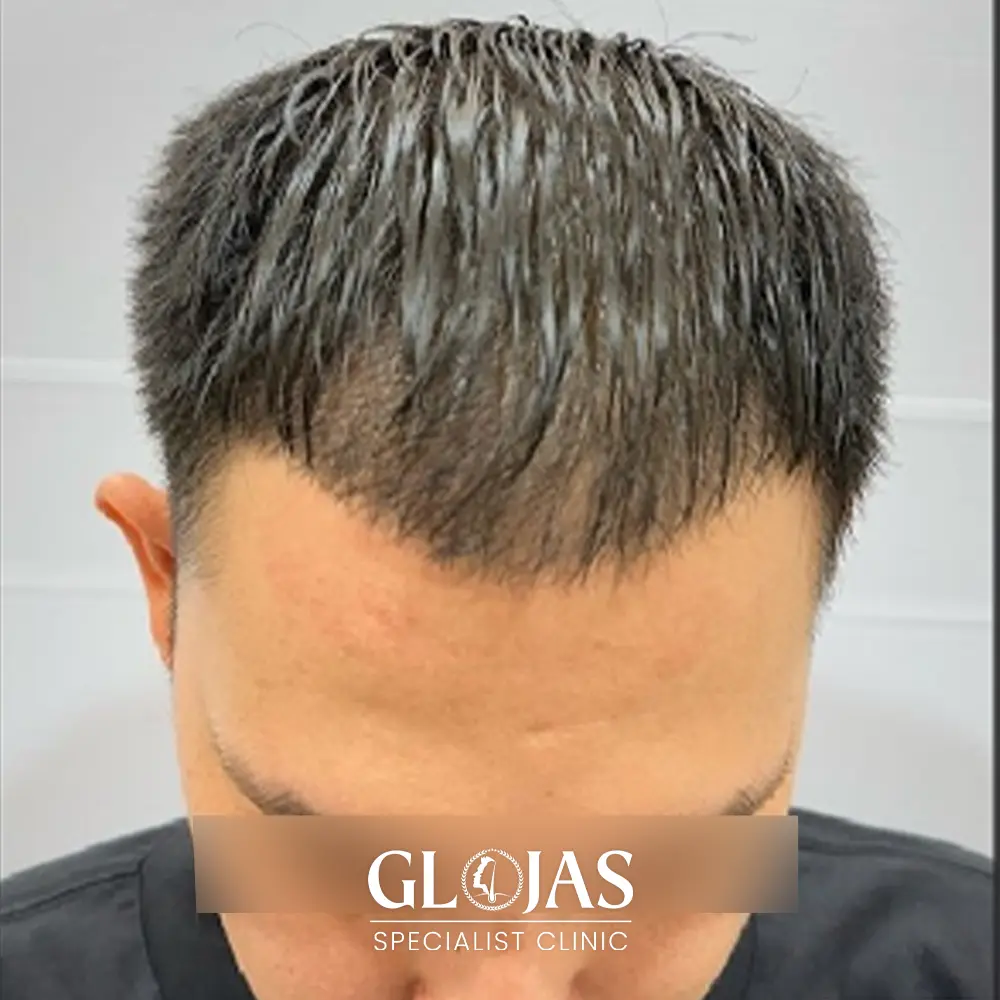 hair transplant malaysia specialist after 5 1