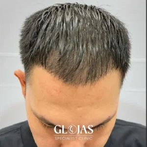 hair-transplant-malaysia-specialist-after-5