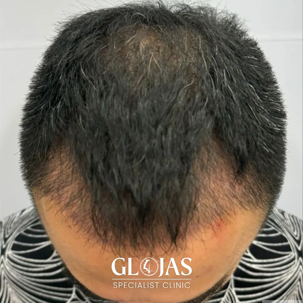 hair transplant malaysia specialist after 6