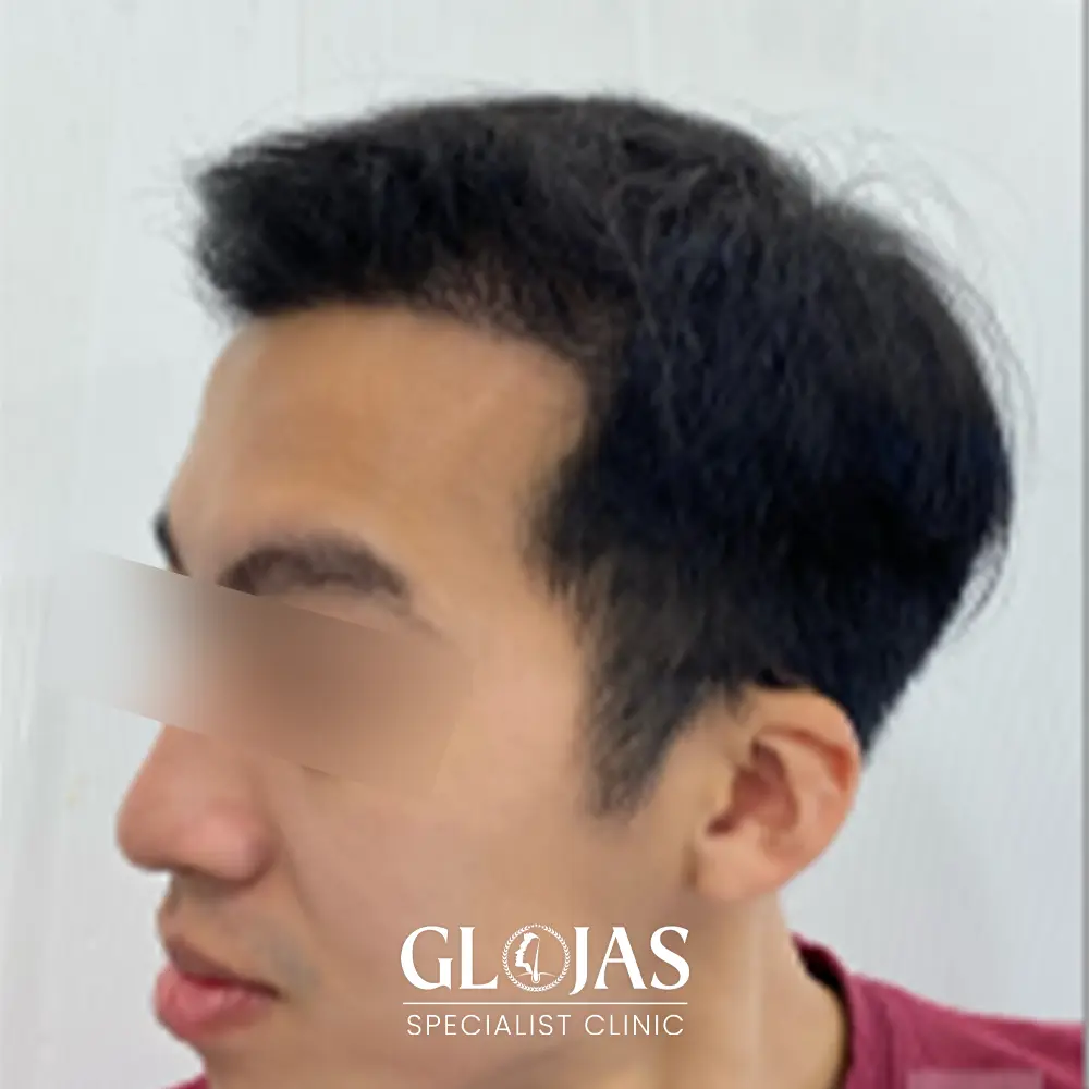 hair transplant malaysia specialist after 7 1