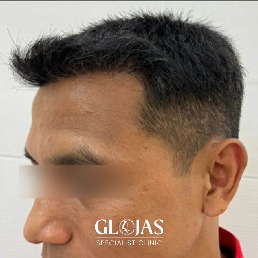 hair transplant malaysia specialist after 9 1