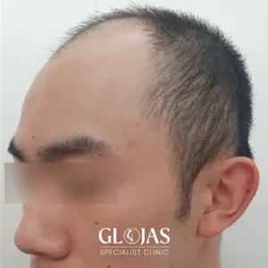 hair-transplant-malaysia-specialist-before-after