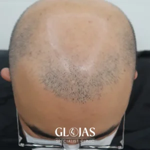 hair-transplant-malaysia-specialist-before-14