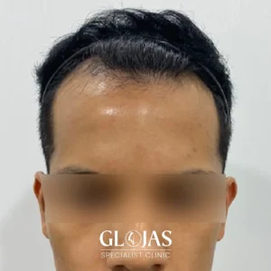 hair-transplant-malaysia-specialist-before-2