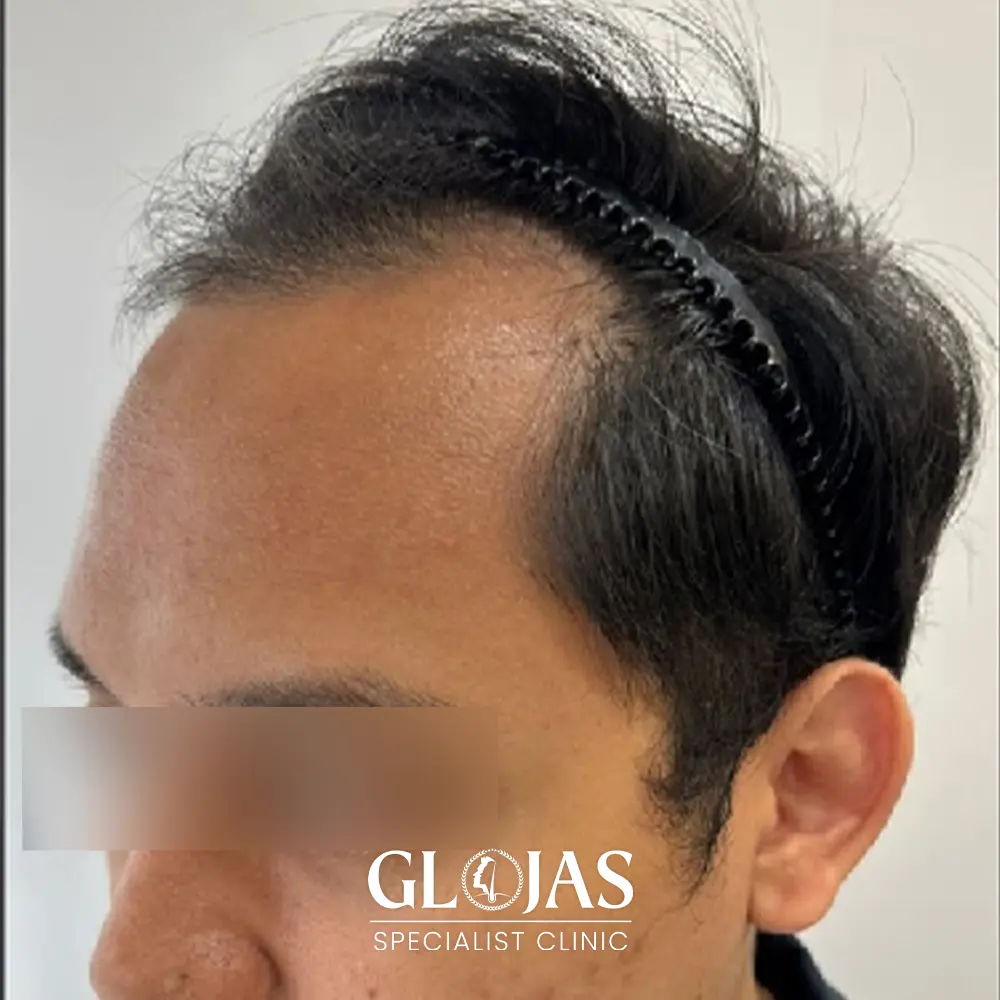 hair transplant malaysia specialist before 3 1