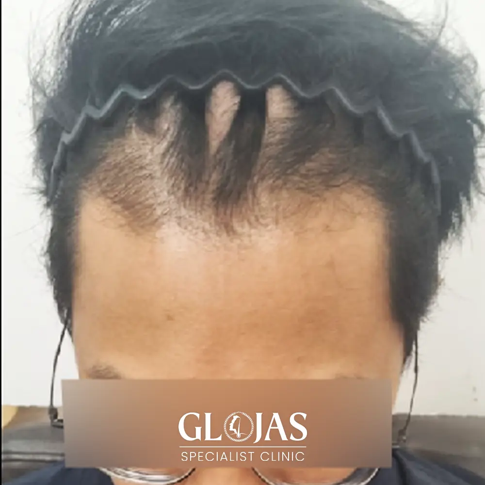 hair transplant malaysia specialist before 4 1