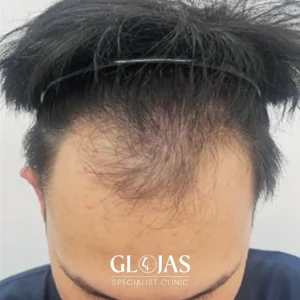 hair-transplant-malaysia-specialist-before-5