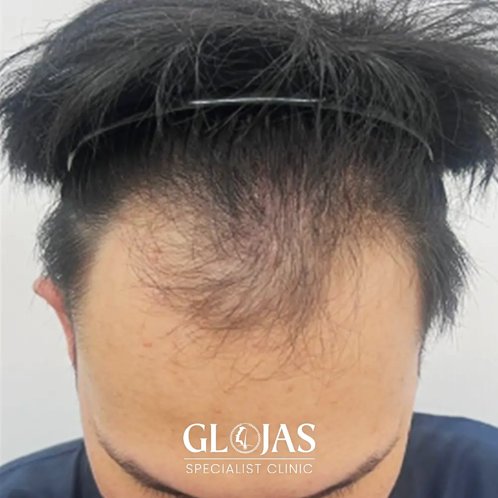 hair transplant malaysia specialist before 5