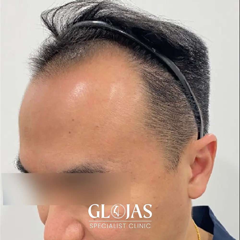 hair transplant malaysia specialist before 6 1