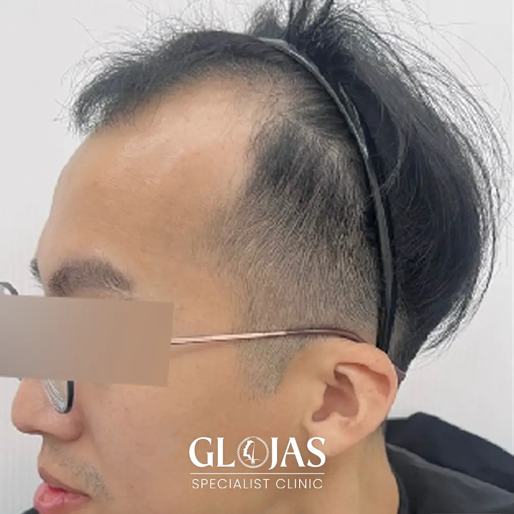 hair transplant malaysia specialist before 7 1