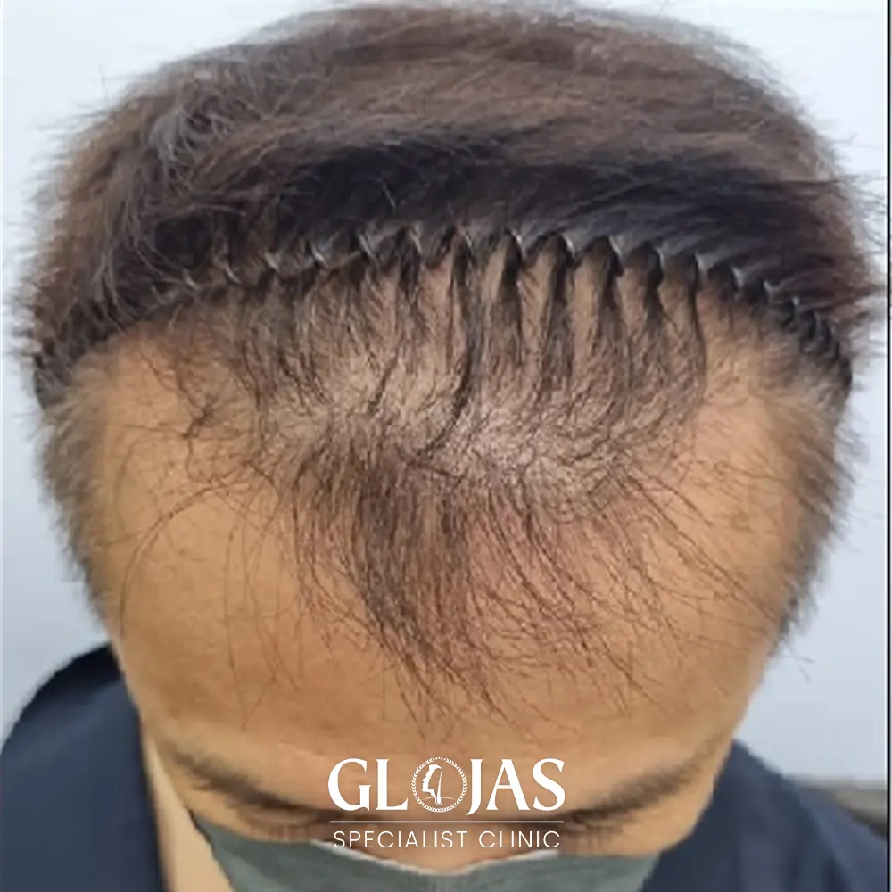 hair transplant malaysia specialist before 8