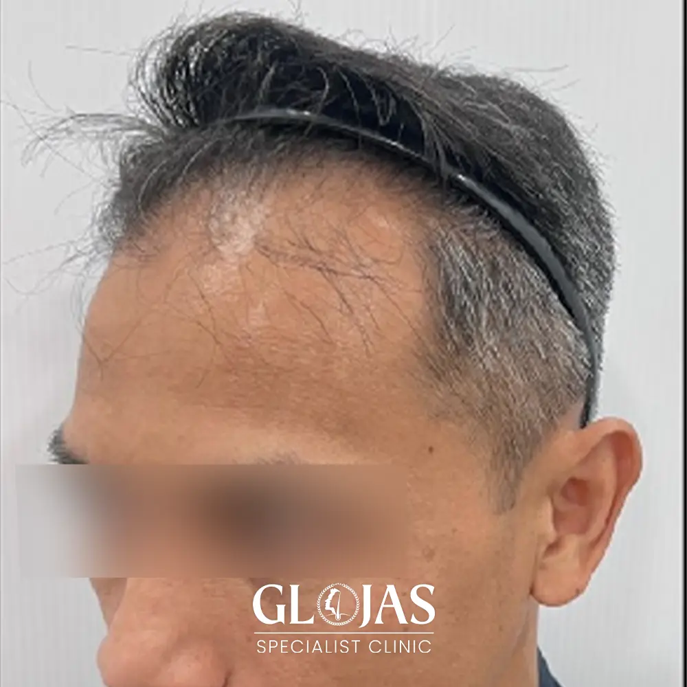 hair transplant malaysia specialist before 9 1