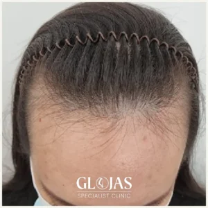 hair-transplant-malaysia-specialist-before-after-2