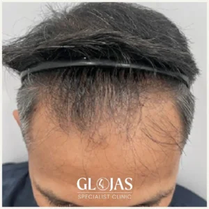 hair-transplant-malaysia-specialist-before-after-3