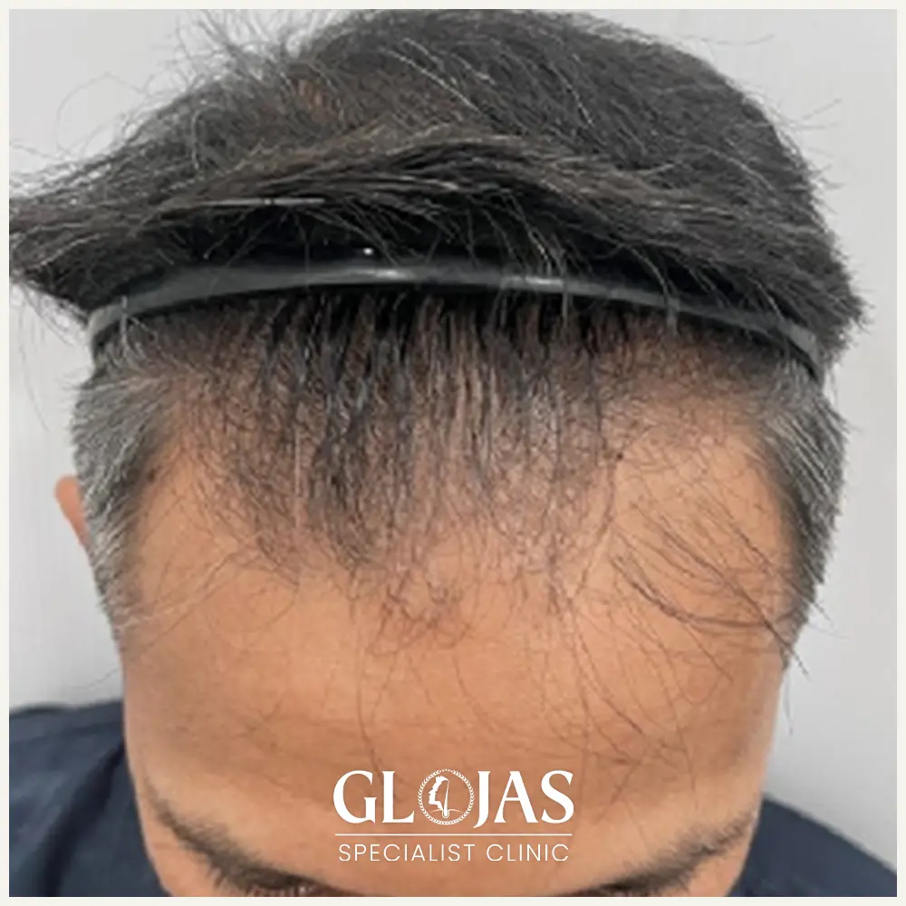 hair transplant malaysia specialist before after 3