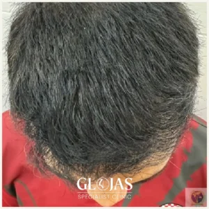 hair-transplant-malaysia-specialist-before-after-4