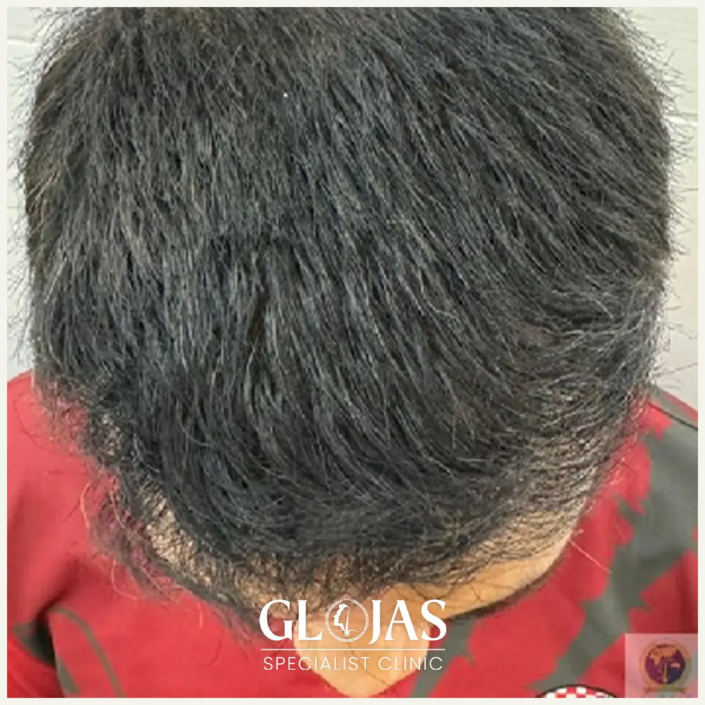 hair transplant malaysia specialist before after 4