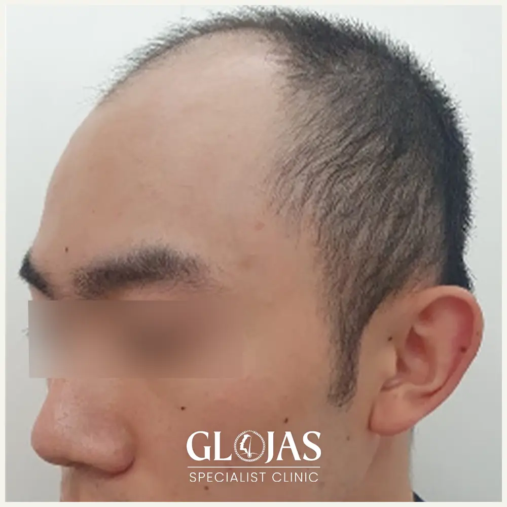 hair transplant malaysia specialist before after 5