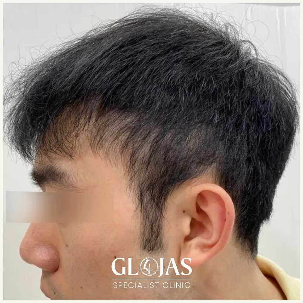 hair transplant malaysia specialist before after 6