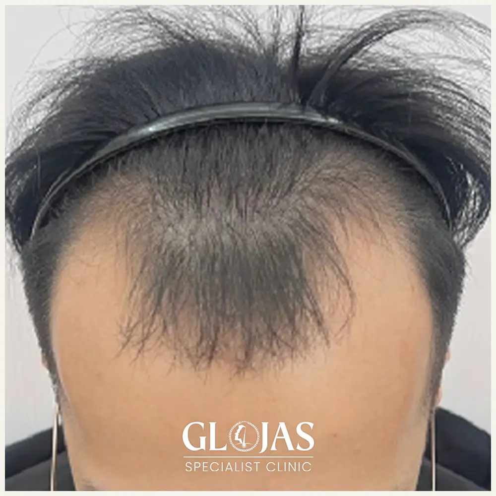 hair transplant malaysia specialist before after 8 1